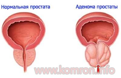 tabobati prostatitis