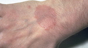 ca. 1960-1990 --- Granuloma annulare lesion on skin of hand. The cause is unknown, but patients with the disease commonly have diabetes mellitus as well. --- Image by © Lester V. Bergman/CORBIS