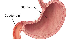 Anterior view of coronal section of the stomach  SOURCE: 116653_1  MOD: Removed duodenal ulcer, added redness for inflammation
Original Exit Writer image is 116114 added peptic ulcer