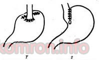gastroesophagectomy