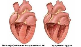 kardiomiopatiya