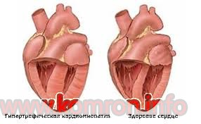 kardiomiopatiya
