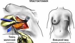 mastektomiya