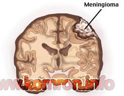 meningioma